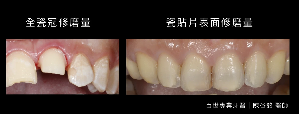 牙冠與貼片修磨量的差別