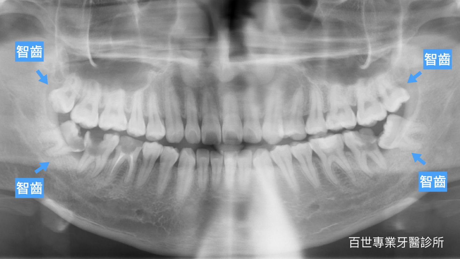百世專業牙醫為您整理了拔智齒看診前必看的 4 大重點,希望能幫助您放下心中的大石頭,安心迎接治療