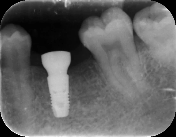 植入在骨頭內的稱做(人工牙根)，用來代替被拔除的牙根
圖：瑞典品牌 Astra EV 植體