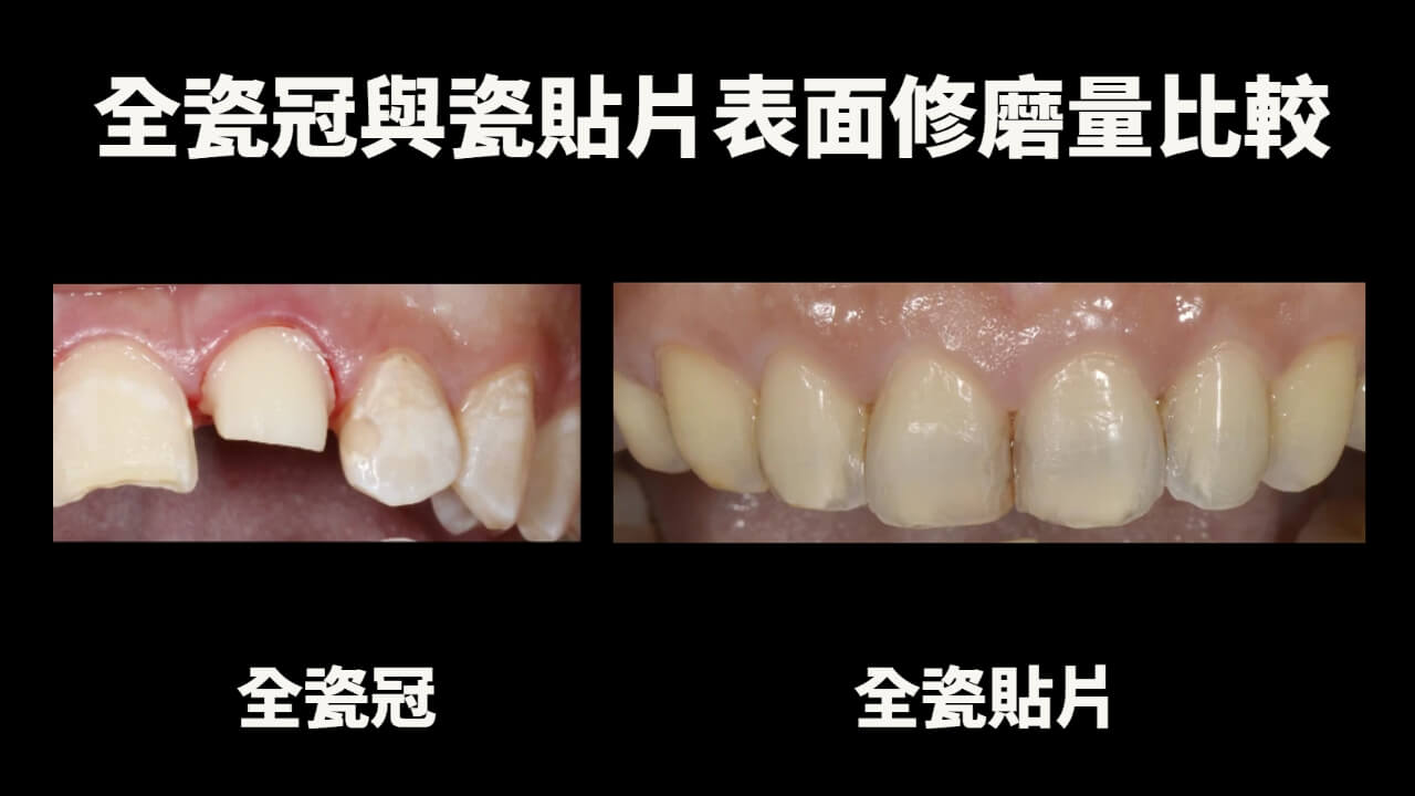 以牙齒外型來看，瓷貼片所需修磨量比全瓷冠少很多，因此瓷貼片算是牙科微創治療的一環。