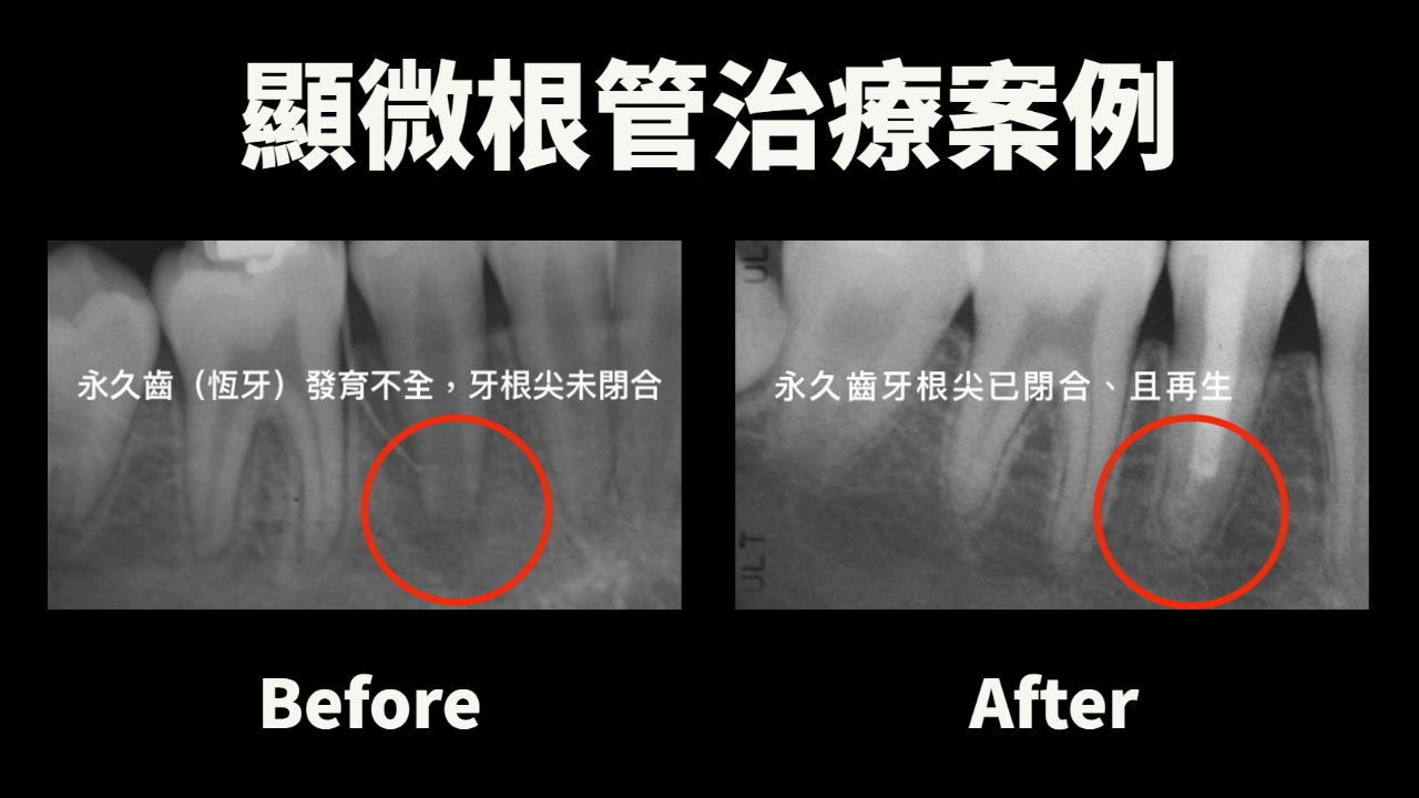 顯微根管治療案例 - 永久齒發育不全