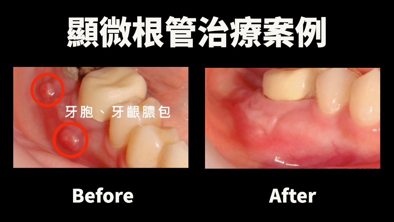顯微根管治療案例 - 牙胞膿包