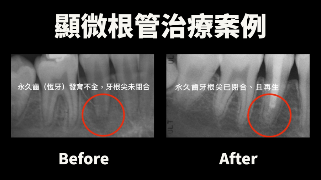永久齒(恆牙)發育不全，牙根尖未閉合的狀況，透過顯微根管治療後，順利閉合再生。