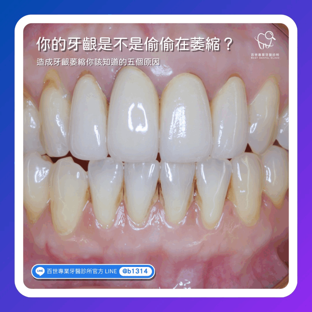 牙齒變長、牙根外露?小心「牙齦萎縮」正悄悄發生!