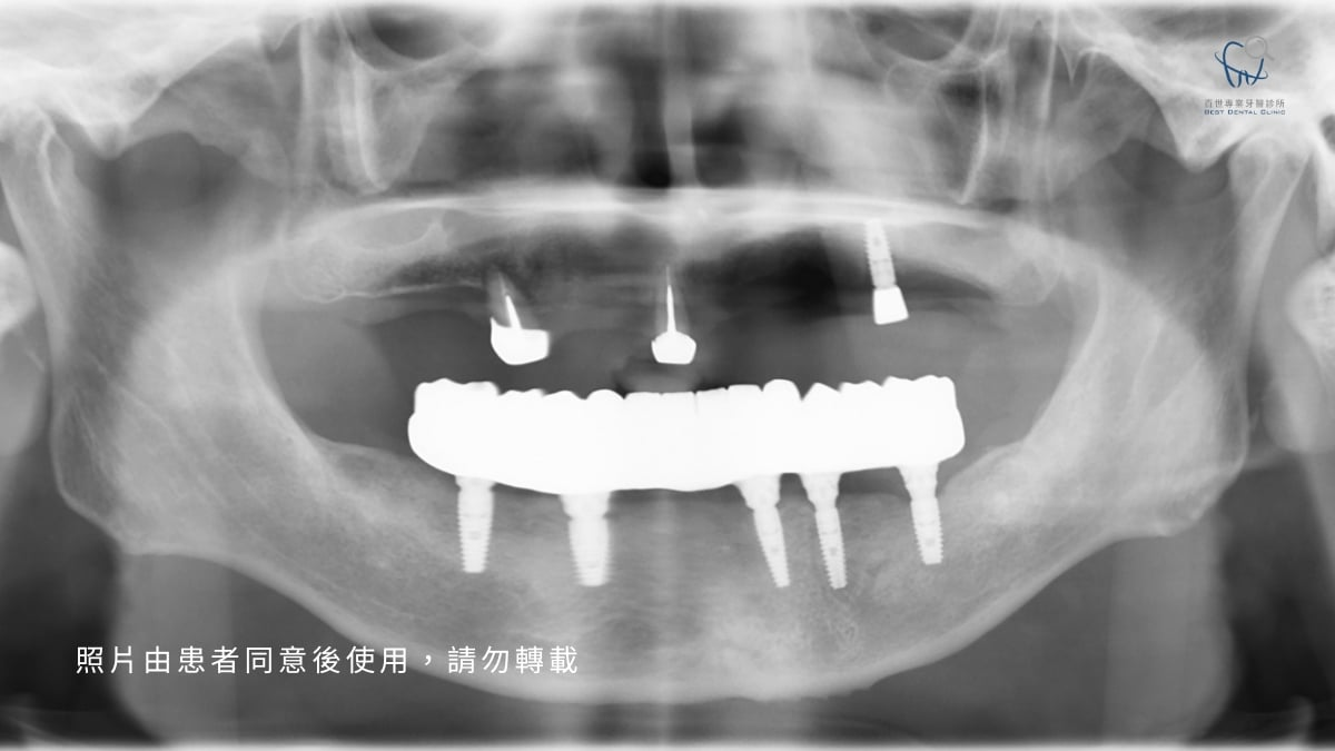 只要地基穩固，植體不一定得砍掉重練。植牙經驗豐富的陳谷銘院長有一套流程，來評估舊植體的去留：