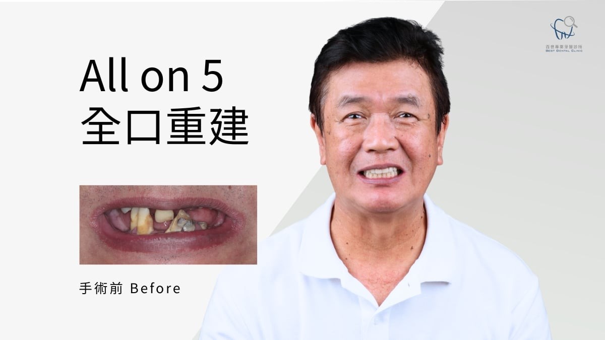 利用 DSD 數位微笑設計結合臉部掃描，預先模擬出最適合老闆的牙齒排列。新的 All-on-5 有效撐起因長期缺牙而萎縮的肌肉，換新假牙後，老闆發現法令紋變淡、臉頰不再凹陷，那份在「烇溙新燒鴨」忙碌時的自信笑容也完全回來了！